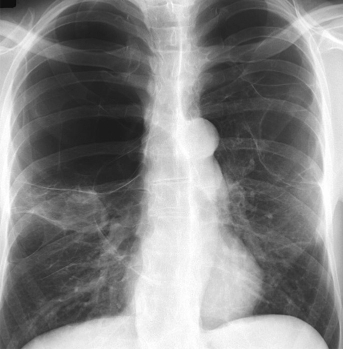 Cannabis Use, Lung Cancer, and Related Issues. J Thorac Oncol. 2018