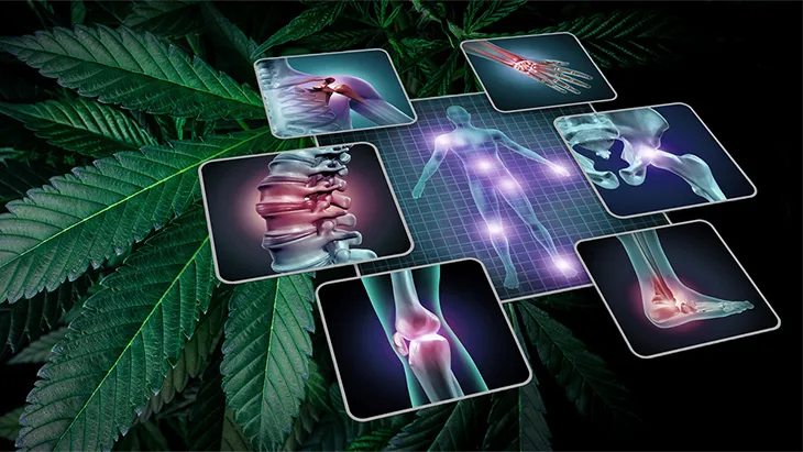 Perceptions and Preoccupations of Patients and Physicians Regarding Use of Medical Cannabis as an Intervention Against Chronic Musculoskeletal Pain: Results from a Qualitative Study. J Pain Res. 2023 Oct