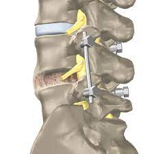 The Association Between Preoperative Cannabis Use and Anxiety, Pain Scores and Opioid Consumption in Patients Undergoing Spinal Fusion: A Retrospective Cohort Study. Global Spine J. 2025