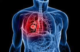 The use of medical cannabis concomitantly with immunecheckpoint inhibitors in non-small cell lung cancer: A sigh of relief?